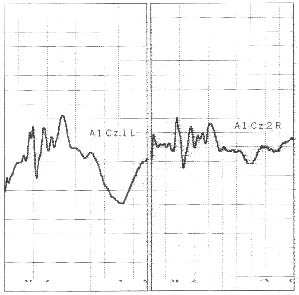BAER Tracing Figure 1 - Bilateral